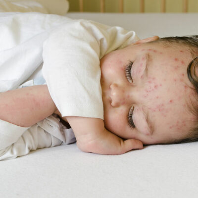 Home care tips for children with chickenpox