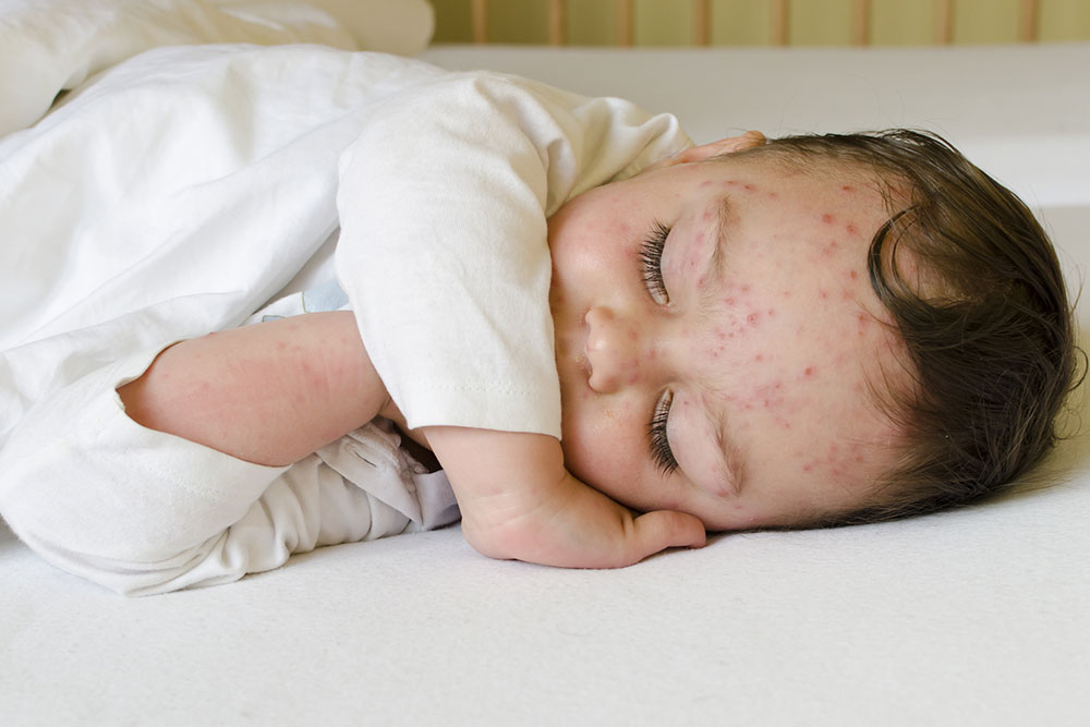 Home care tips for children with chickenpox