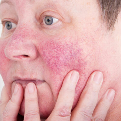 Rosacea &#8211; Types, treatments, and prevention