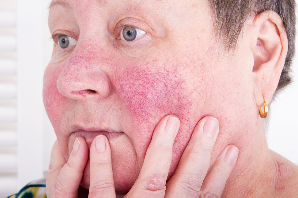 Rosacea &#8211; Types, treatments, and prevention