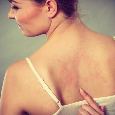 6 Health Conditions Linked to Psoriasis