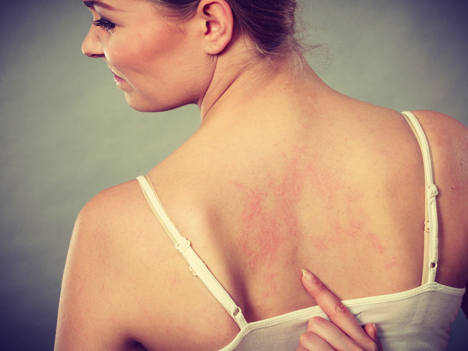 6 Health Conditions Linked to Psoriasis