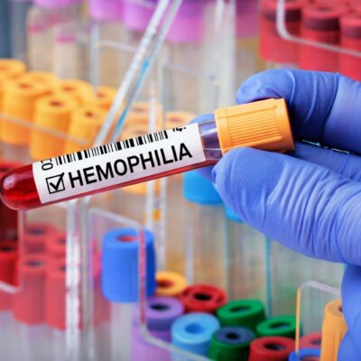 5 Common Symptoms of Hemophilia