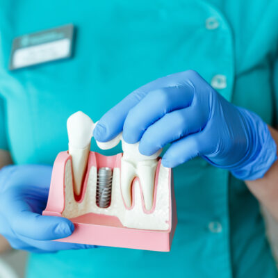 Dental Implant Cost: Instant Ways to Save on Dental Implants